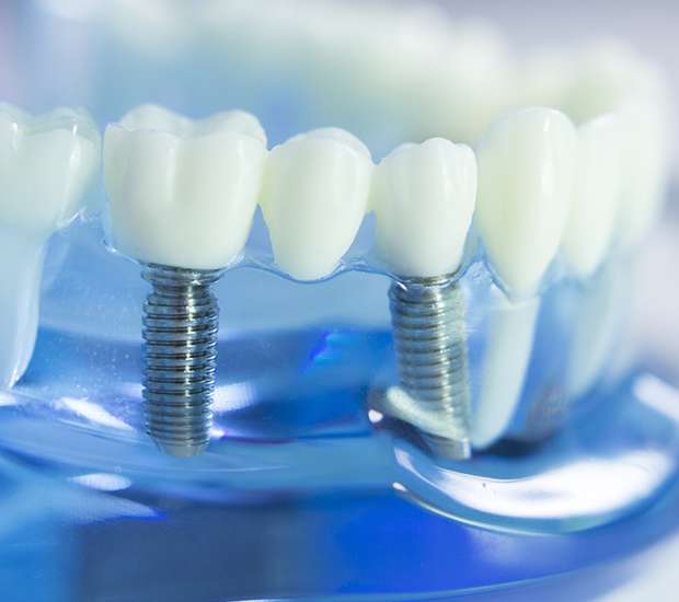 Bellevue Dental Implants