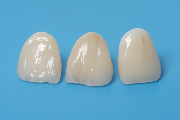 Same Day Crowns Vs  Traditional Crowns: Which Is Right For You?